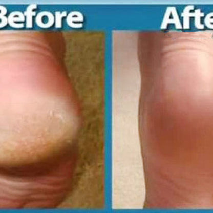 Massage Foot Crack And Apply Foot Cream